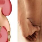 Riješite se kamena u bubregu prirodnim putem za samo 6 dana